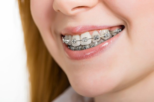 ortodoncja-exceldent-nowoczesna-stomatologia-w-szczecinie